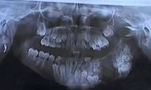 dente