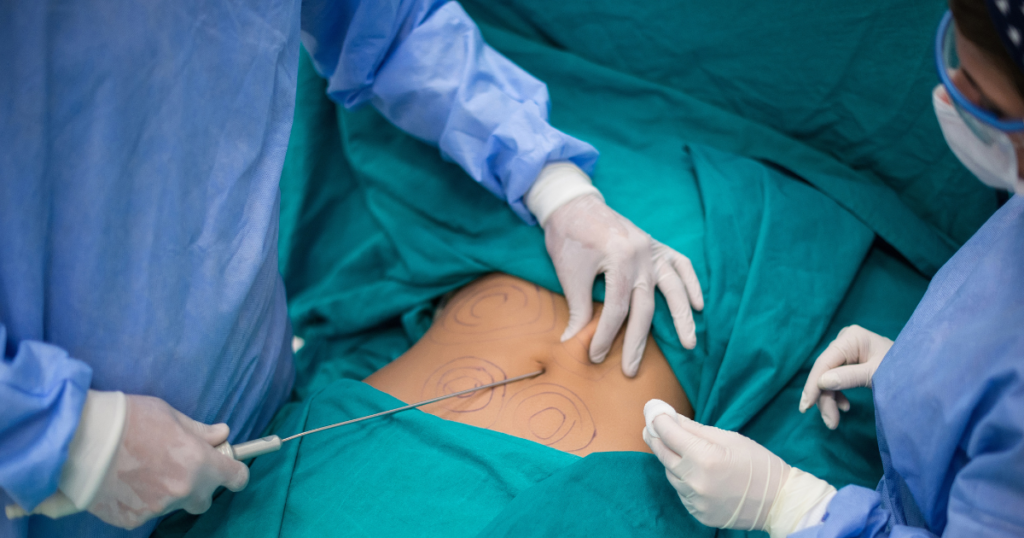quais-os-riscos-da-lipoaspiracao-e-da-cirurgia-realizada-por-luana-andrade