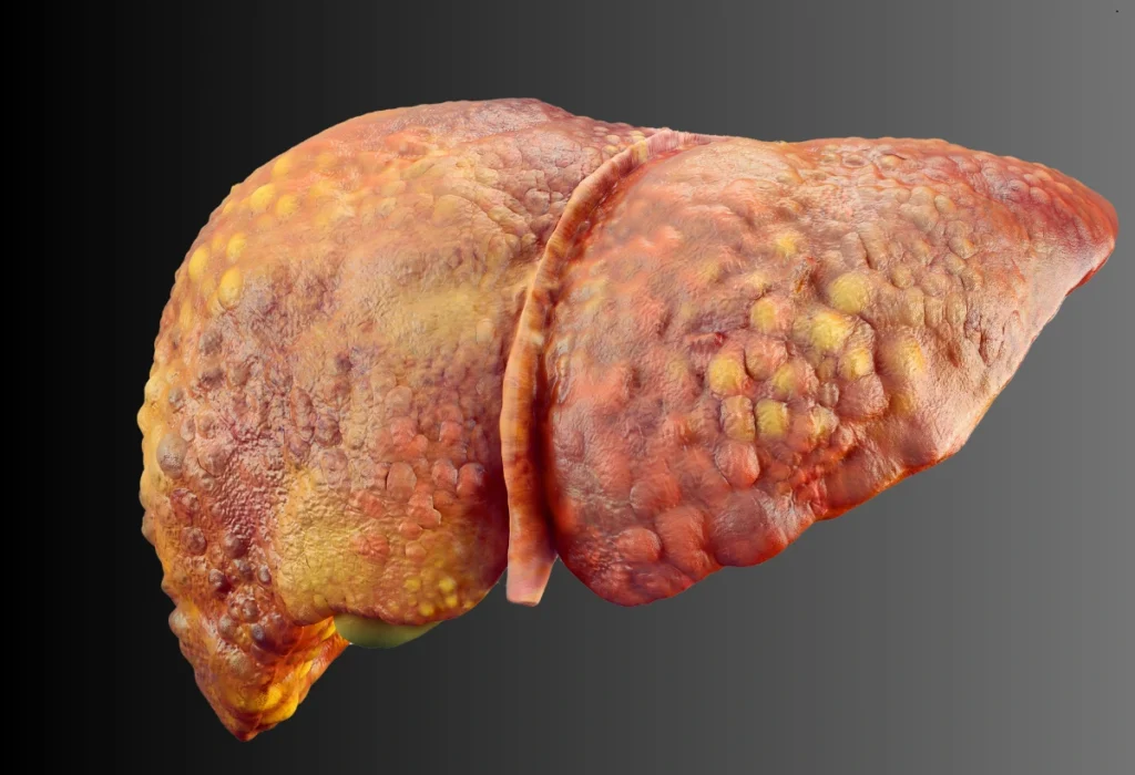 entenda-ate-onde-a-gordura-no-figado-pode-regredir,-quando-a-regeneracao-do-orgao-deixa-de-funcionar-e-quais-sinais-mostram-que-e-hora-de-buscar-ajuda-profissional.