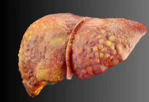 entenda-ate-onde-a-gordura-no-figado-pode-regredir,-quando-a-regeneracao-do-orgao-deixa-de-funcionar-e-quais-sinais-mostram-que-e-hora-de-buscar-ajuda-profissional.