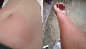 alergia-a-agua:-rondoniense-luta-contra-doenca-rara-que-transforma-ate-o-suor-em-risco